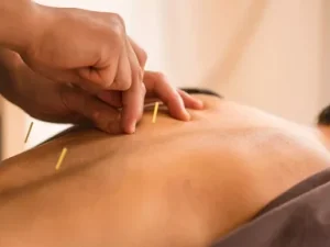 acupuncture in Newport Beach