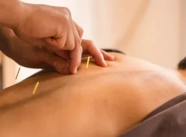 acupuncture in Newport Beach