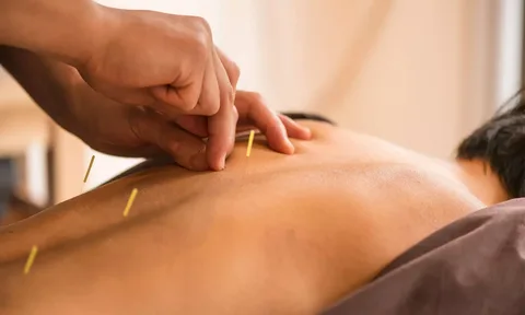 acupuncture in Newport Beach