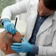 Hair Transplant